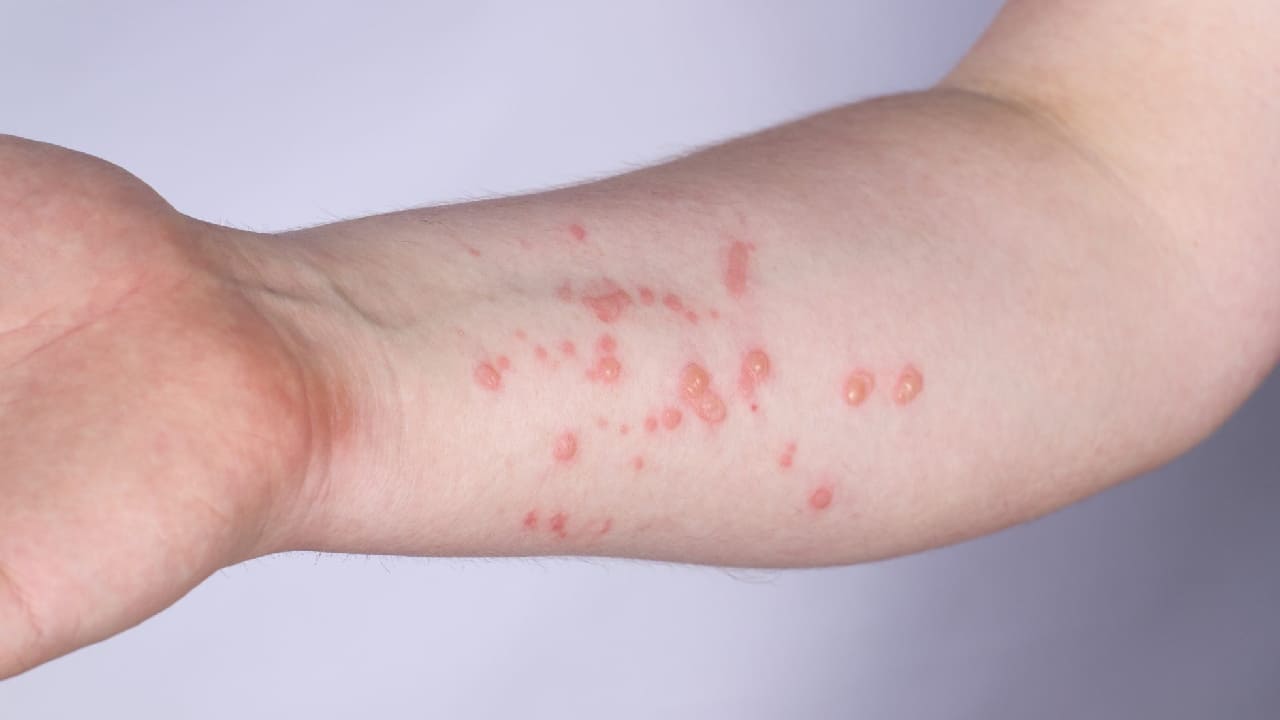 What Are the Symptoms of Chickenpox