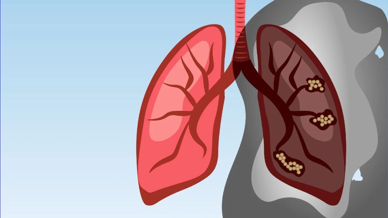 What Are the Symptoms of Lung Cancer