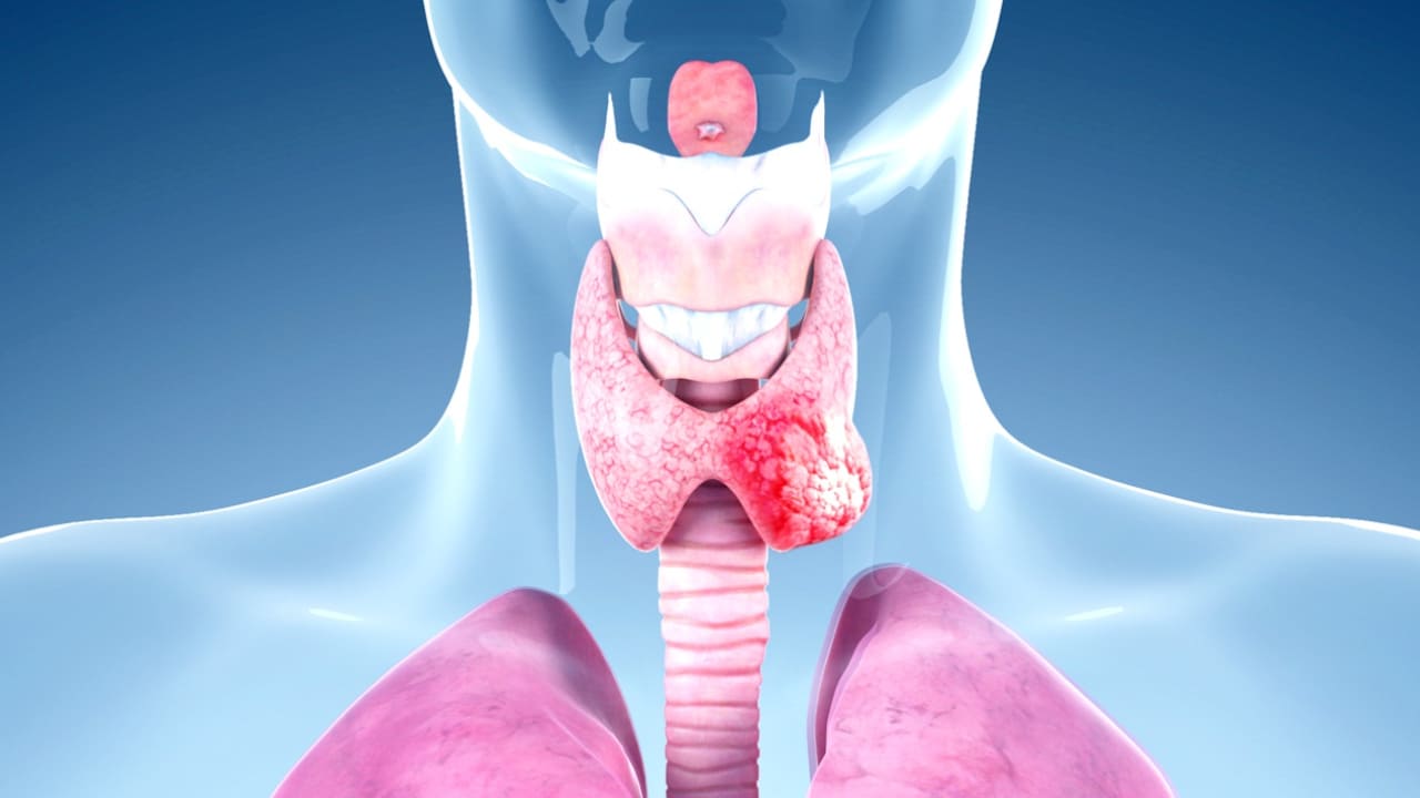 What Are the Symptoms of Throat Cancer